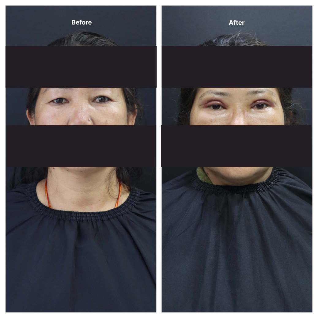 Eyelid Surgery KOQ10